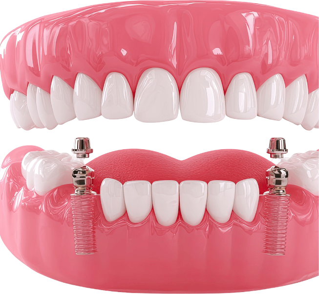 All-on-4 Dental Implants Burlington