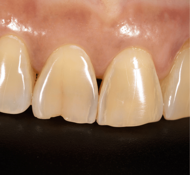 Broken or Chipped Tooth Repair Burlington