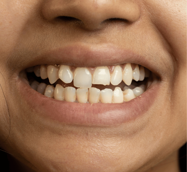 Full Mouth Reconstruction in Burlington