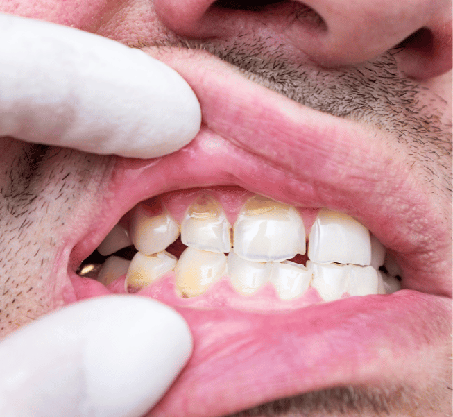 Broken or Chipped Tooth Repair Burlington
