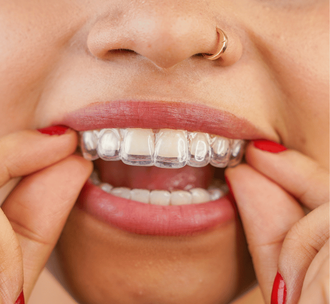 Clear Aligners in Burlington