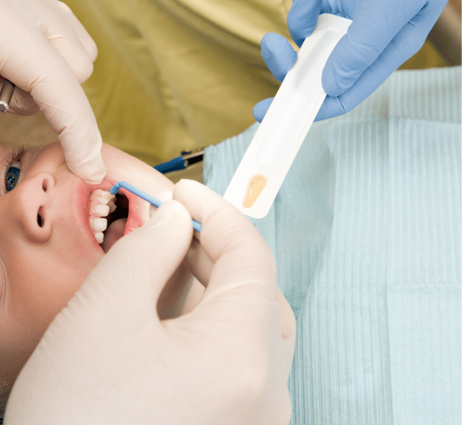 Fluoride Treatments for Kids in Burlington