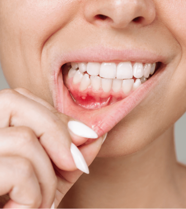 Gum Disease Prevention & Treatment in Burlington