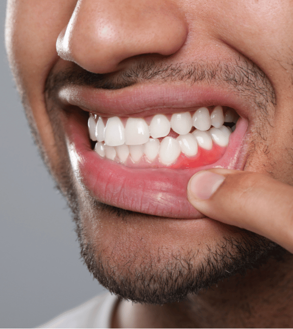 Gum Disease Prevention & Treatment in Burlington