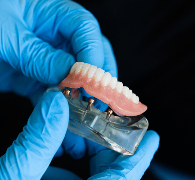 Implant-Supported Dentures Burlington