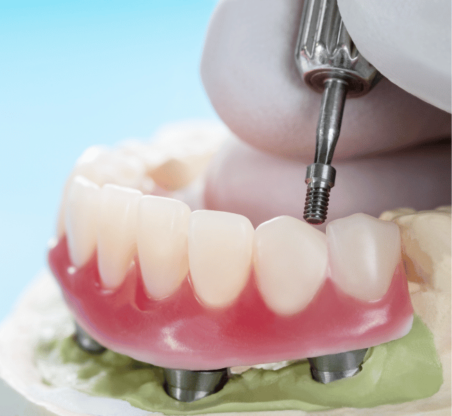 Dental Crowns in Burlington