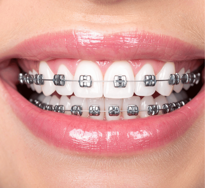 Invisalign for Teens