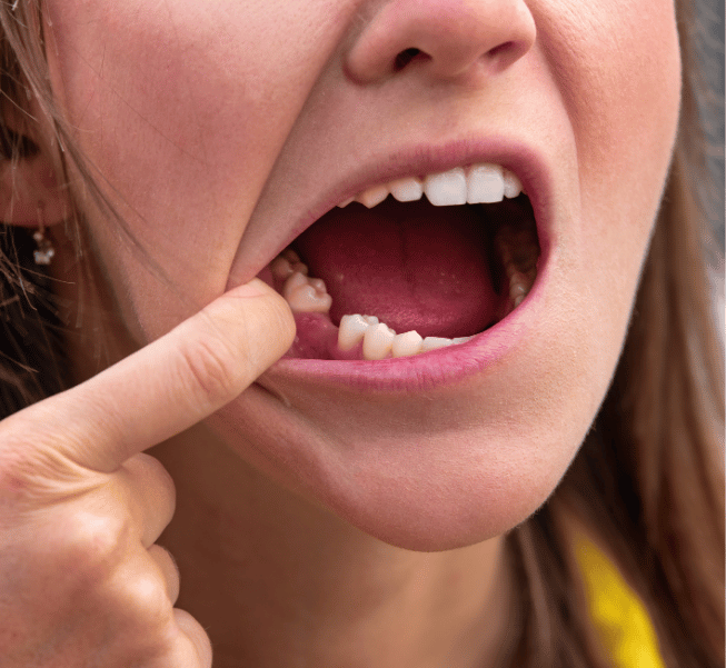 Full Mouth Reconstruction in Burlington