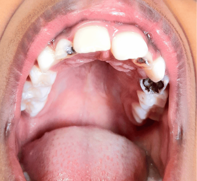 Full Mouth Reconstruction in Burlington