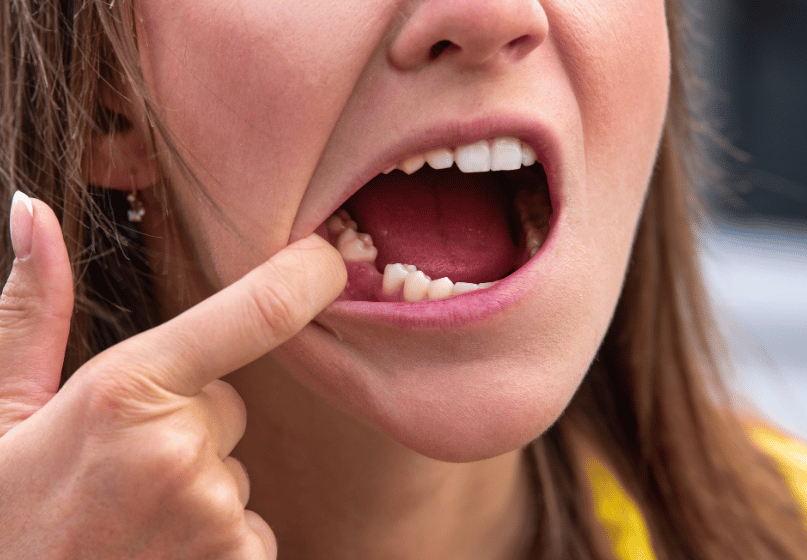 Tooth Extractions Burlington