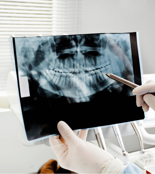 Dental Crowns in Burlington