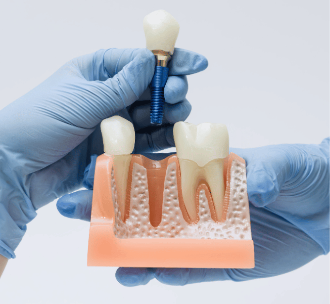 Dental Crowns in Burlington
