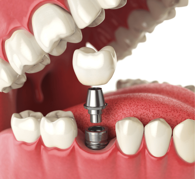 Single Tooth Dental Implants Burlington