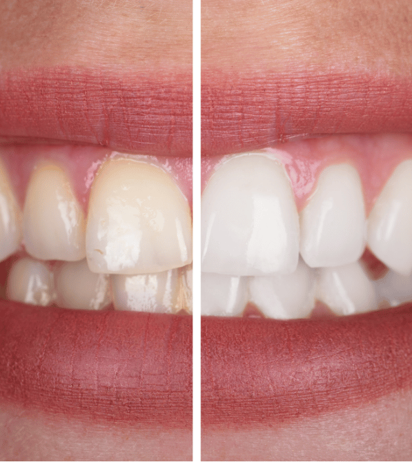Teeth Whitening in Burlington