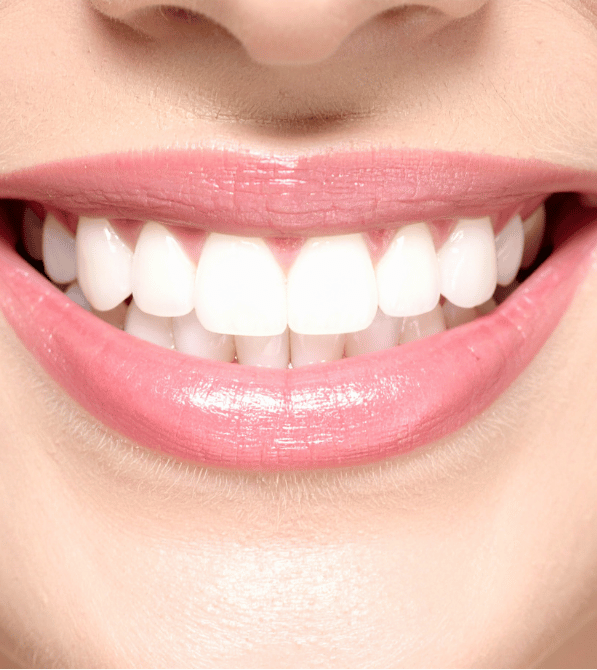 Dental Crowns in Burlington