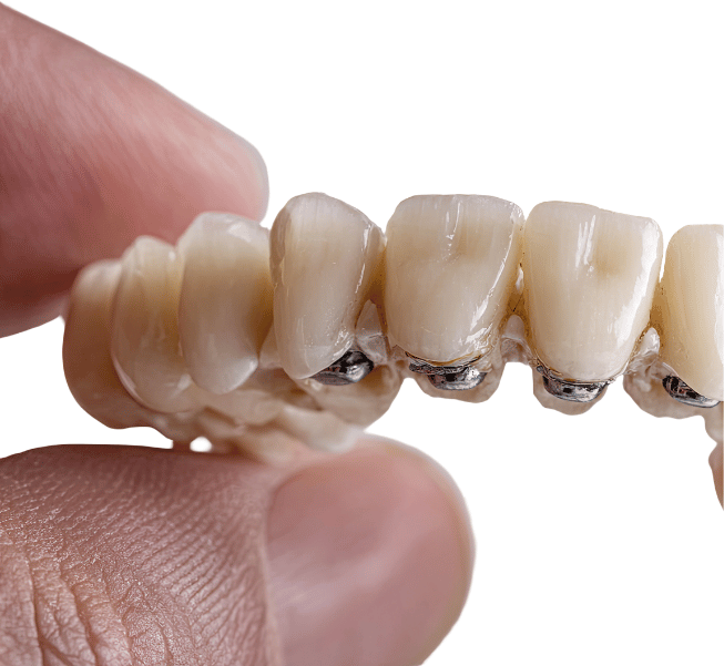 dental bridge 2