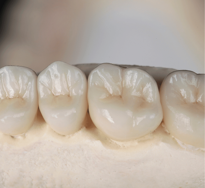 dental crowns 2