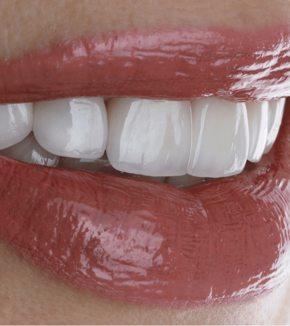 porcelain veneers burlington